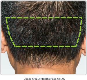 artas_hair_restoration_donor_area_before