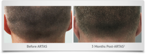 columbus_ohio_hair_transplant_donor_area-3_months_after
