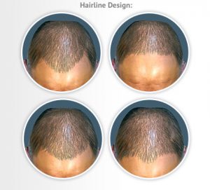 hairline-design