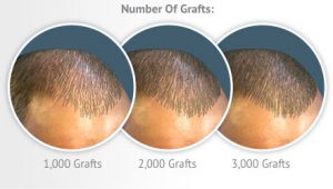 number-of-grafts